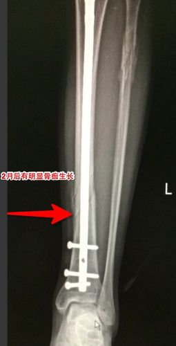 其它 田氏伤科医院--骨折大问题微创小切口帮您解决 写美篇胫腓骨骨折