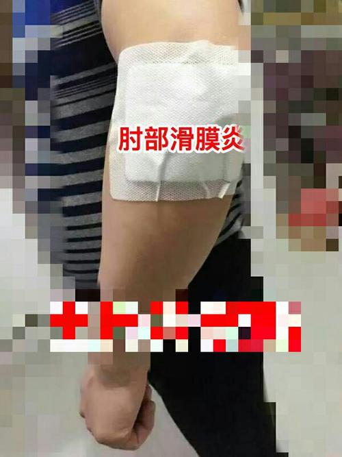 肘部滑膜炎贴法