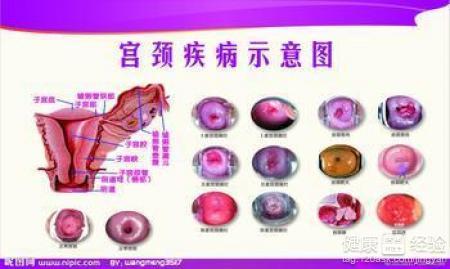 慢性宫颈炎如何治疗