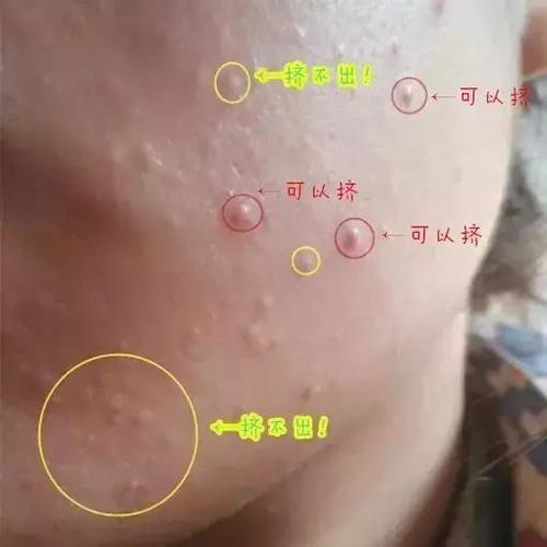 (华美真实案例) 别小看它 闭口粉刺最难搞的就是 挤