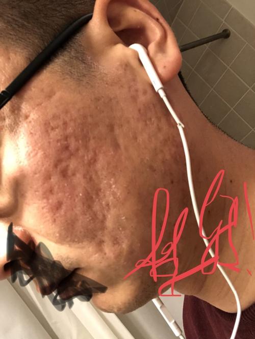 因为脸上有很多痘疤而心理自卑,能否从心理学的角度帮