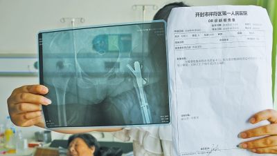 老人的x光片和诊断报告单