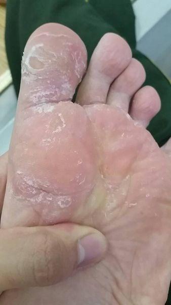 请问脚是什么情况奇痒无比,而且脱皮