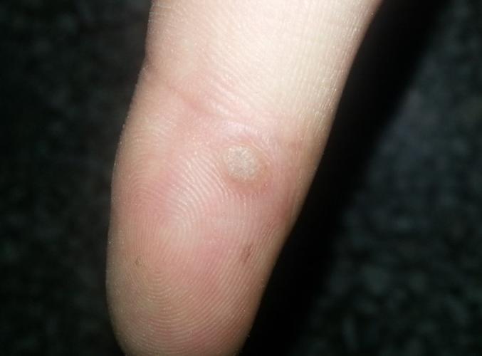 问:请问下照片中的是鸡眼还是疣