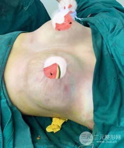 乳房缩小术照片对比照片原来胸大也是有烦恼的