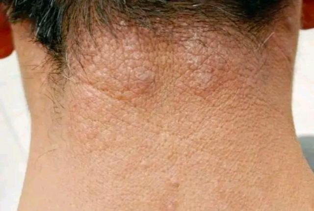 神经性皮炎肥厚,苔癣样变的皮肤