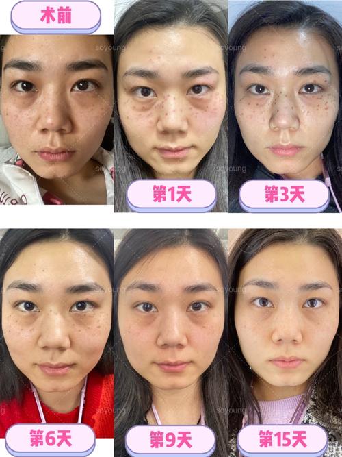 三位数做的激光祛斑遭遇意外惊喜