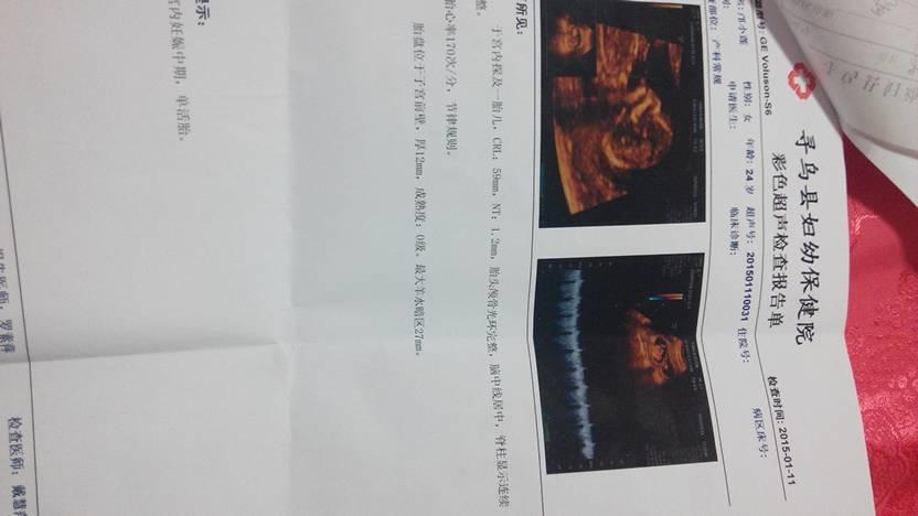 孕3个月b超能看出是男宝还是女宝吗