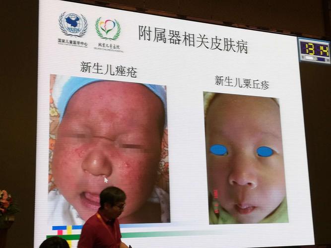 写美篇 (五)新生儿自身免疫性皮肤病 1,新生儿红斑狼疮 主要治疗是1