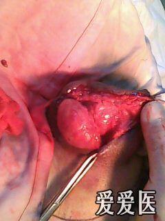 阴囊外伤,睾丸脱出 有图