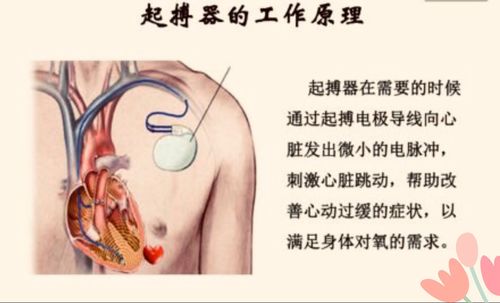 现在来了解下心脏起搏器的工作原理和类型