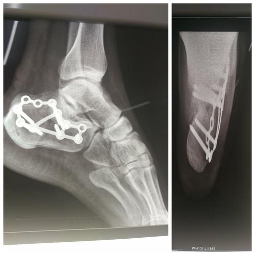 浅谈跟骨骨折治疗经验分享