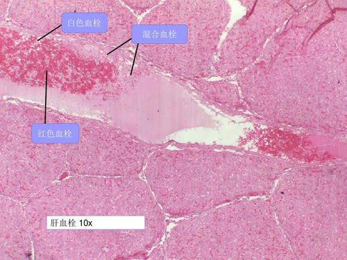 白色血栓混合血栓 红色血栓 肝血栓 10x