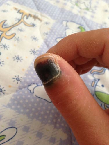 今年端午节时候,手指甲被车门夹了,到现在半个月了,指甲根部和整个