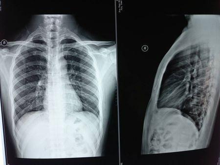 胸透.医生说可能是血管,也有可能是感染.有多大几率是感染了.好担心!