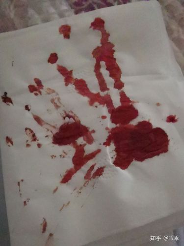 长期自残,因为喜欢鲜血,疼痛会减少病发的痛苦.