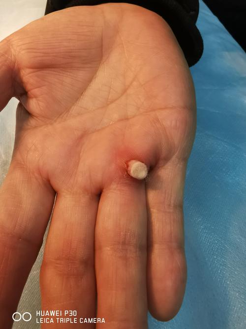 化脓性肉芽肿冷冻治疗