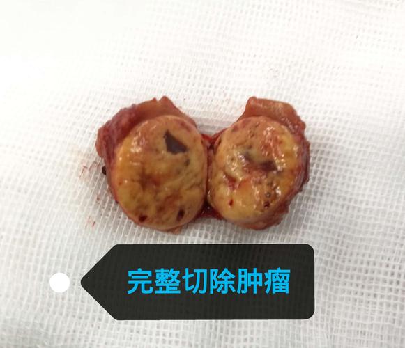 5cm将肿瘤完整剜除