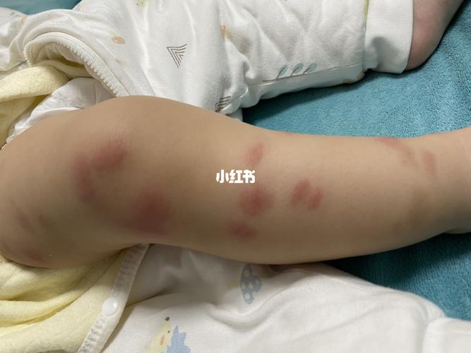 止痒_宝宝衣物_膏药_床品_螨虫_母婴_育儿经验