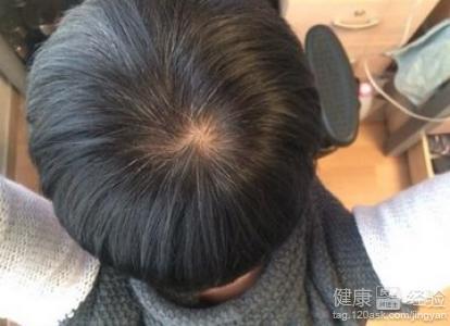 白发怎么办