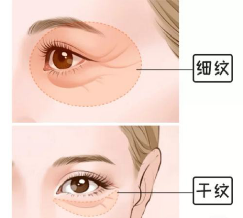 眼纹分为细纹和干纹,两者有什么不同呢?