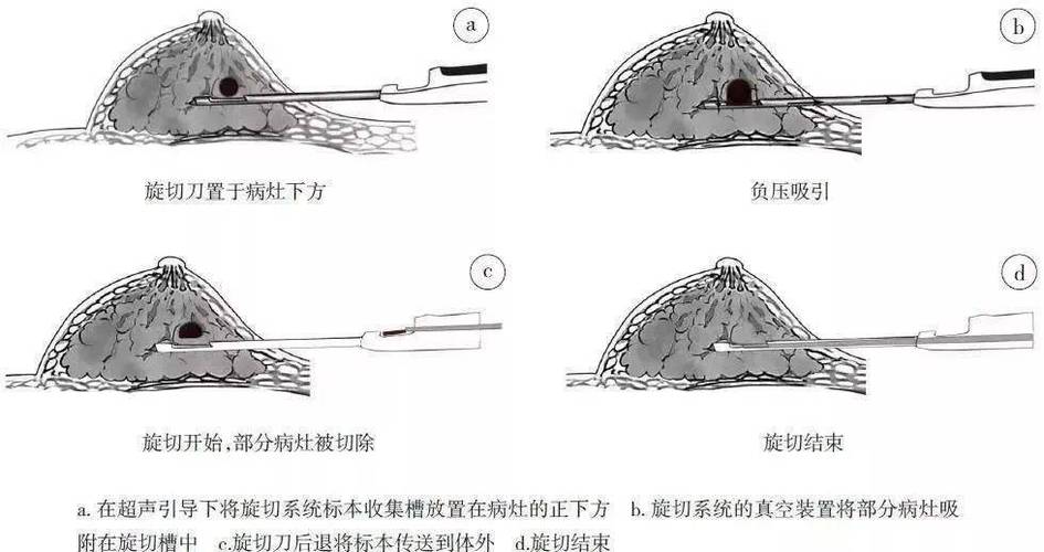 乳腺肿物不用慌,无痛微创旋切保乳不留痕!