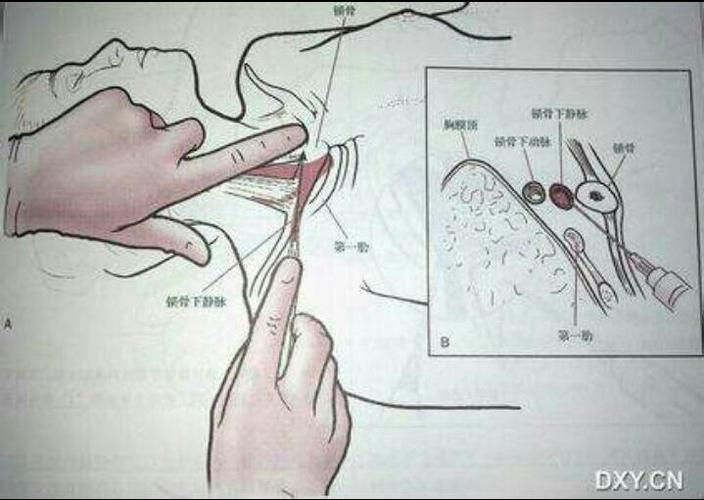 锁骨下静脉穿刺解剖图解