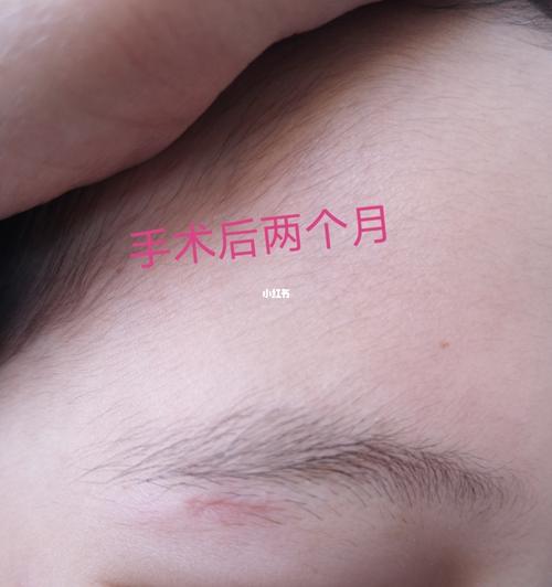 脸部皮脂腺囊肿术后恢复情况_疤痕_祛疤膏_创口贴_防晒_帽子_医疗健康