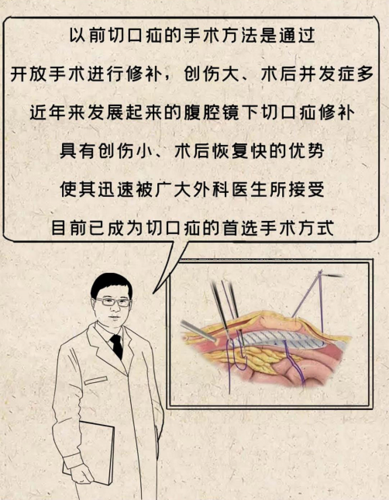 疝病专家董擂带你了解腹壁切口疝的治疗