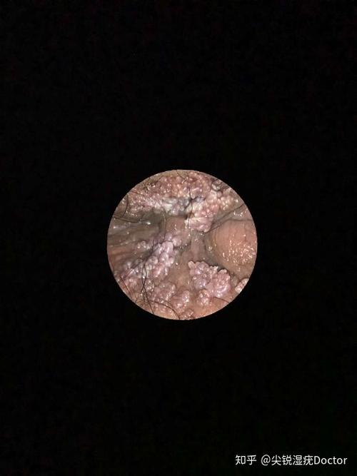 尖锐湿疣肛周疣体症状图片