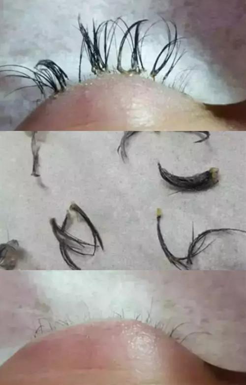 种睫毛导致睫毛集体脱落,眼睛还红肿发炎