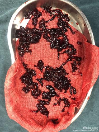 1例左髂静脉压迫合并左下肢急性髂股静脉血栓病人的治疗