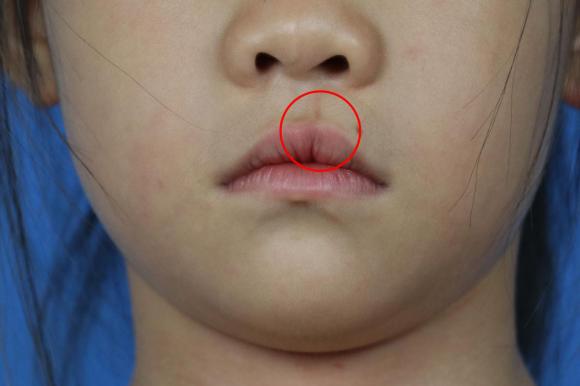 唇裂修复较好的医院怎么选择