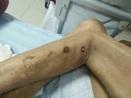 护理压疮之心得