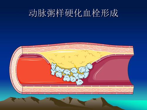动脉粥样硬化血栓形成