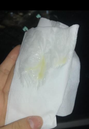 白带一直这个色儿白带常规没有啥大问题是宫颈炎吗颜色发绿