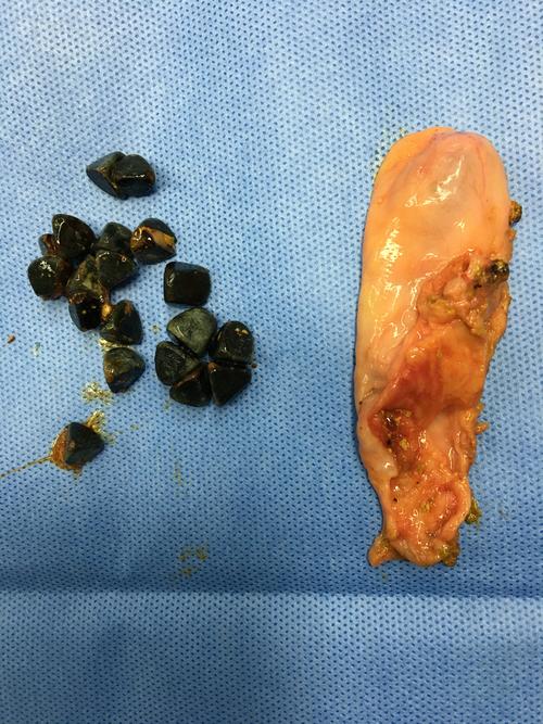 充满型胆囊结石建议尽早手术