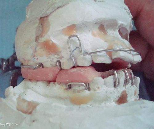 twin-block功能矫治器图1图2图3图4