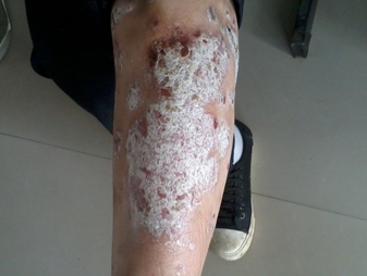 遗传鱼鳞病传女吗