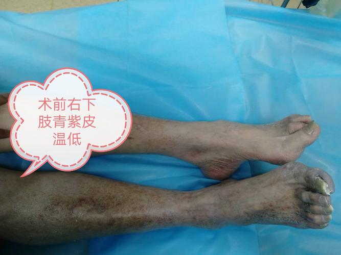 三石说脉管疾病一急性下肢动脉栓塞治疗篇