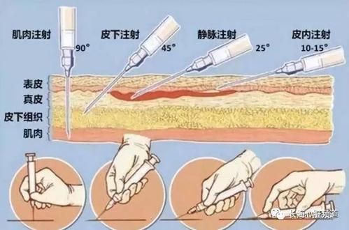 比如卡介苗);还有一种是斜着进针,药物在皮下鼓起一个小包,(这种叫皮