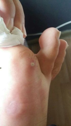 大母脚趾头长了个白色的痘痘一样的东西,碰着会疼,不知道什么东西?