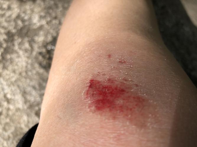 我的受伤的膝盖呀