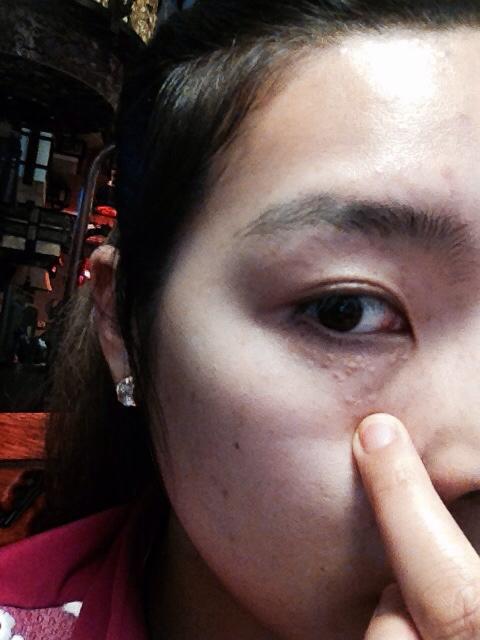 眼睛下面长了很多小颗粒不知道是脂肪粒还是汗管瘤大家帮忙辨别下,好