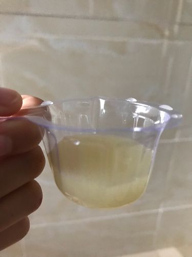 我的尿液是怎么了?怎么变成这样了?