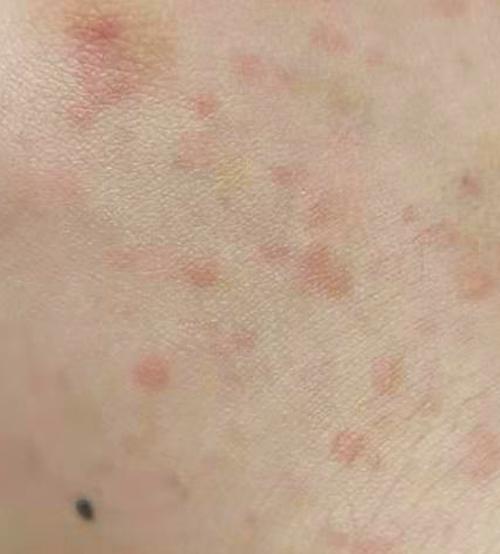 过敏的皮肤