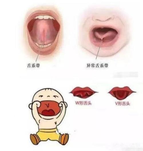 宝宝舌系带短剪还是不剪