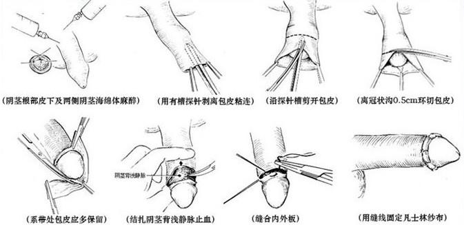 包皮过长手术过程