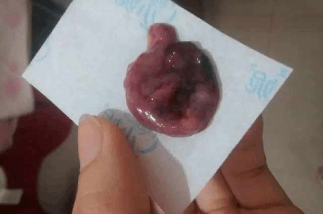 它竟然会随时夺走胎儿!99%的准妈妈,对它不太了解!