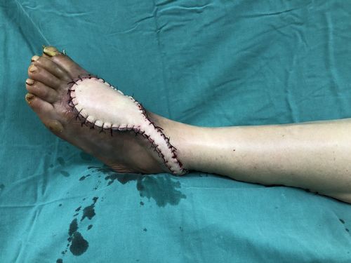 足背创面皮瓣修复